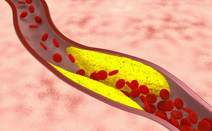 Aterosclerosi: un peptide endogeno abbassa i livelli di colesterolo