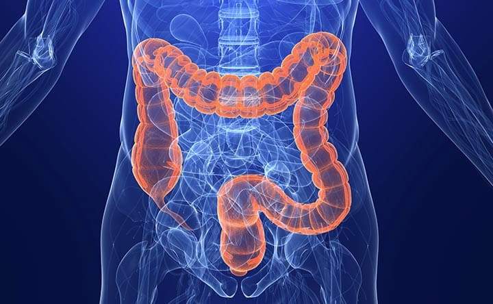 Tumore del colon retto: il colesterolo potrebbe essere utilizzato per la diagnosi precoce